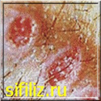 Признаки сифилиса - фото 